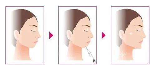 玻尿酸豐下巴前后的區(qū)別