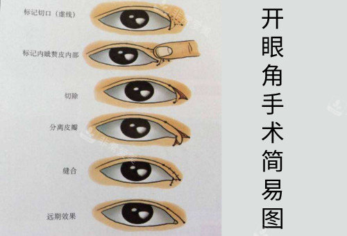 開眼角手術(shù)簡易動(dòng)畫圖