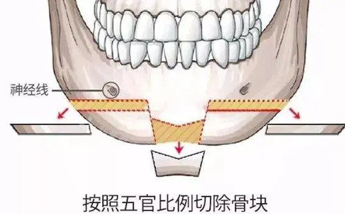 下頦T型截骨示意圖 下頦T型截骨示意圖
