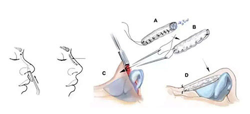 隆鼻手術(shù)方法圖