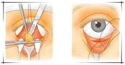 內(nèi)切法祛眼袋卡通示意圖