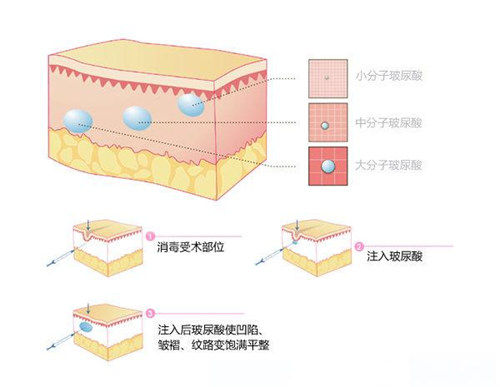 大中小分子玻尿酸注射皮層位置動畫圖