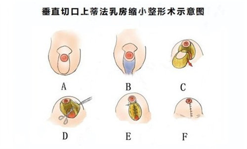 縮胸手術(shù)