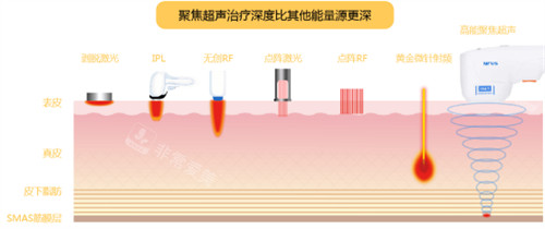 超声炮作用深度演示动画图