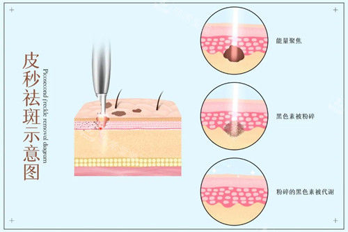皮秒祛斑示意图