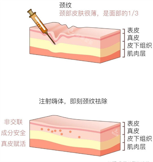 嗨體注射皮層動畫演示圖