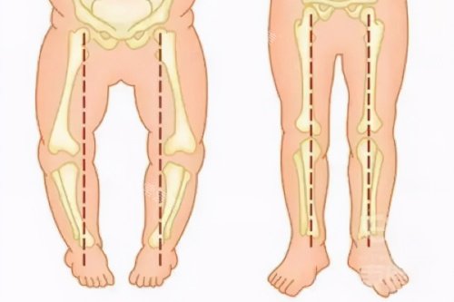 O型腿与正常腿型对比图