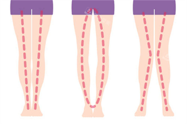 不同腿型的样子图解