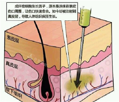 生長因子的副作用解析