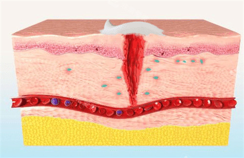 生长因子可以促进皮肤疤痕修复