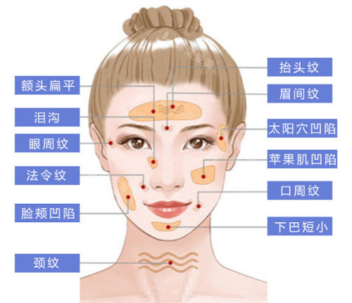 面部脂肪填充部位展示图