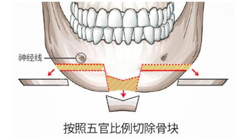 T型截骨術(shù)手術(shù)演示動畫圖