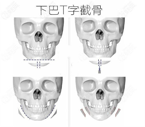 T型截骨術(shù)手術(shù)步驟動畫圖