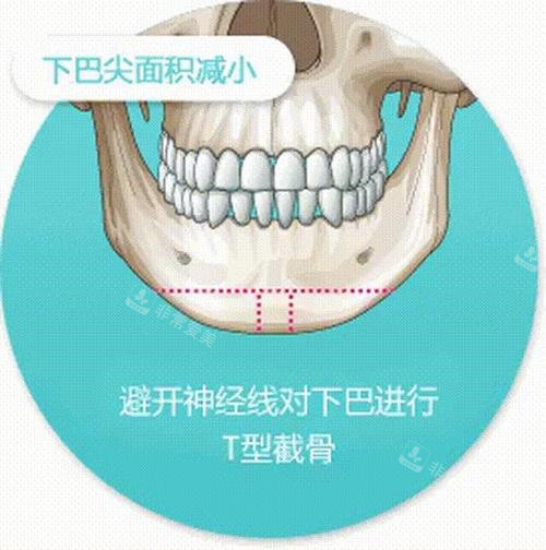 T型截骨术手术切口线演示图