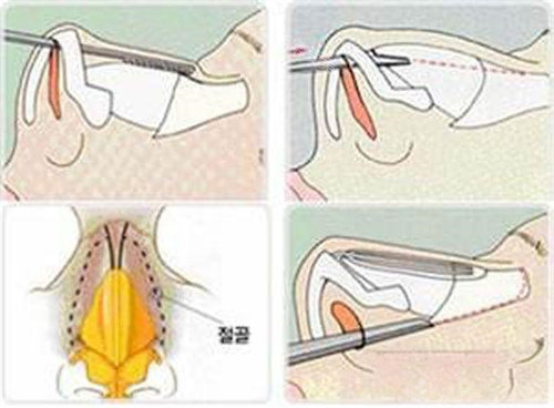 驼峰鼻截骨术步骤动画演示图