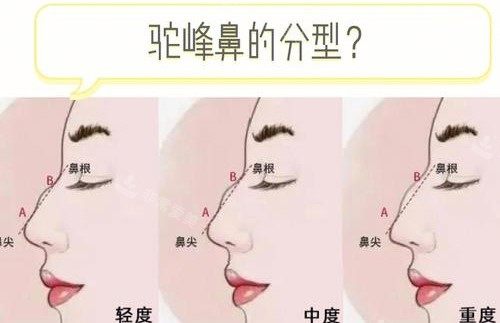 駝峰鼻分型演示動(dòng)畫圖