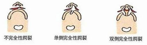 唇腭裂不同類別動(dòng)畫圖