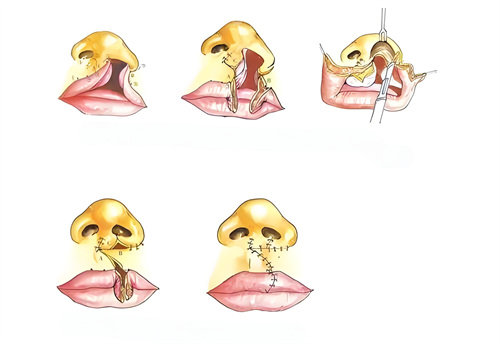 唇腭裂手術(shù)步驟演示動(dòng)畫(huà)圖