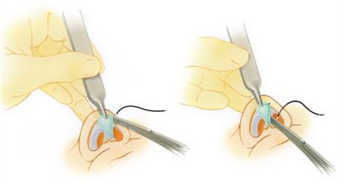 misko埋线隆鼻步骤动画演示图