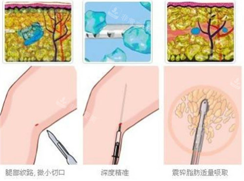 手臂吸脂原理与对比动画图