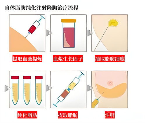 自體脂肪隆胸手術過程演示動畫圖