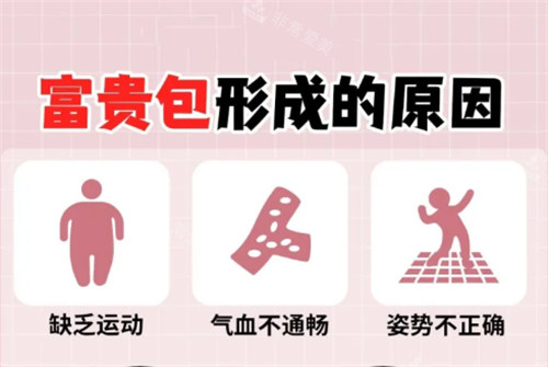 富貴包形成的原因 富貴包形成的原因