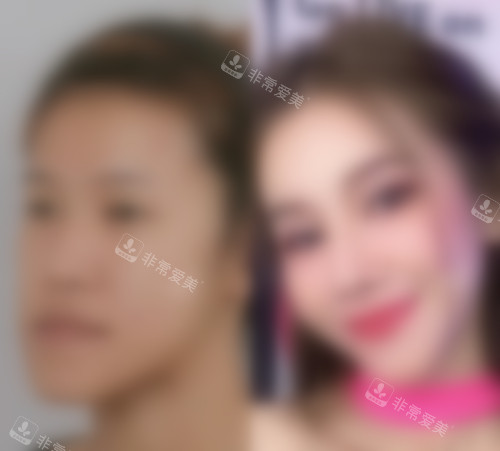 韓國ID醫(yī)院雙鄂手術(shù)前后對比圖