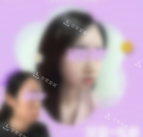 韓國必嫵整形醫(yī)院雙鄂手術(shù)真人實(shí)例