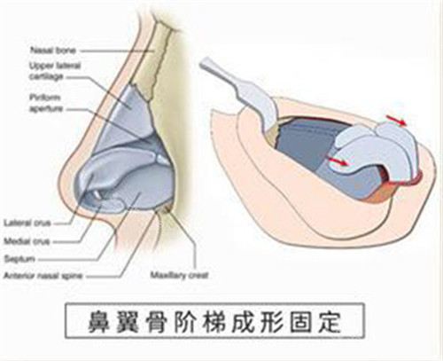 鼻翼骨阶梯成形固定