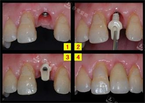 种植牙步骤演示图