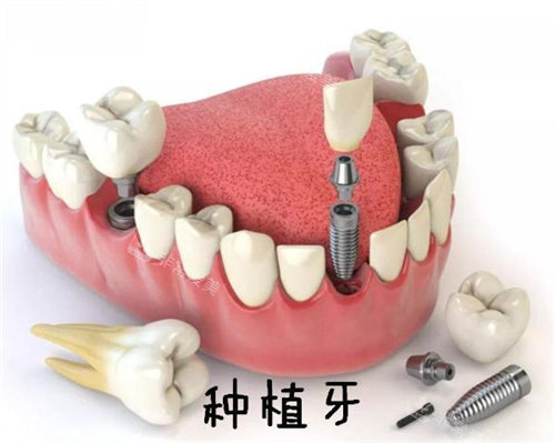 種植牙原理演示動(dòng)畫圖