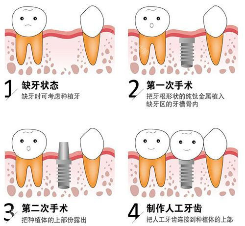 种植牙手术步骤演示动画图