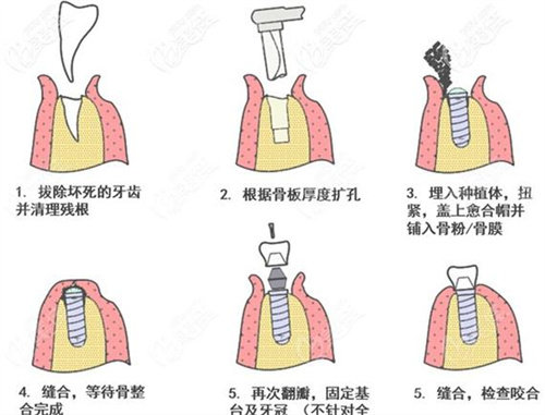 种植牙详细步骤方式演示动画图