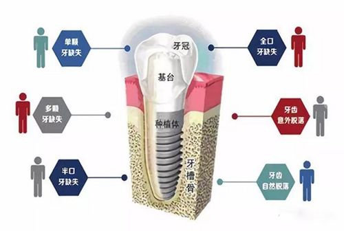 種植牙適合人群動畫演示圖