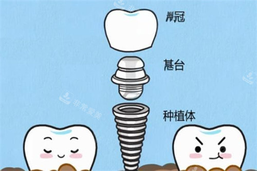 種植牙三部分演示動(dòng)畫(huà)圖
