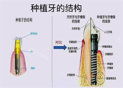 种植牙结构演示动画图