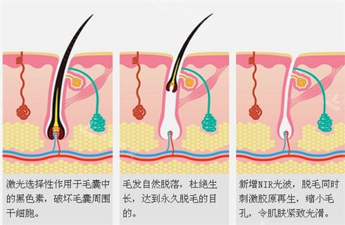 激光脫毛原理