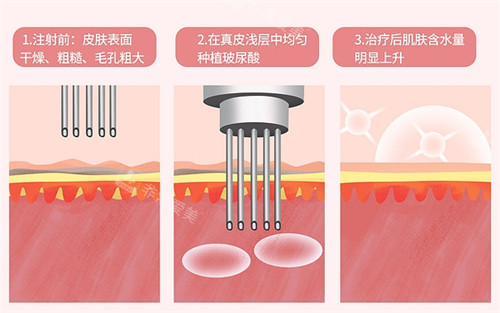 水光前后皮膚對(duì)比