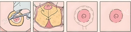 双环切口缩乳术