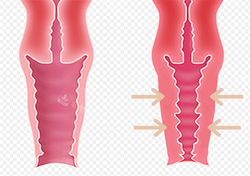深圳缩阴手术哪家医院好？曝光阴道紧缩真实价格是多少！