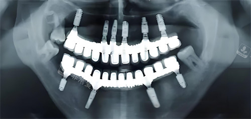 全口种植术前检查ct演示图