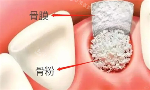 牙科骨粉和骨膜动画演示图