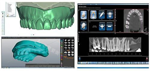 数字化种植牙扫描与建模演示图
