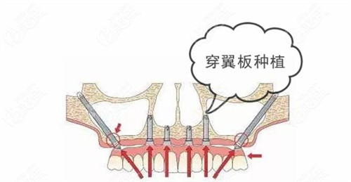 牙穿顴種植手術原理演示動畫圖