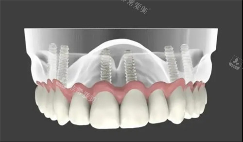 牙穿顴種植手術(shù)原理演示圖