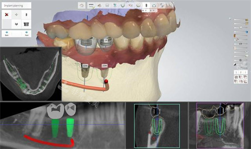 數(shù)字化種植牙建模演示圖