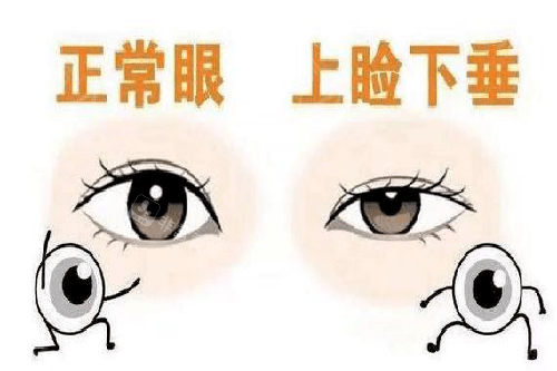 正常眼和眼瞼下垂對(duì)比 正常眼和眼瞼下垂對(duì)比
