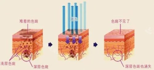 韓國祛斑技術(shù)真牛，我多年的頑固性色斑終于去除干凈了！