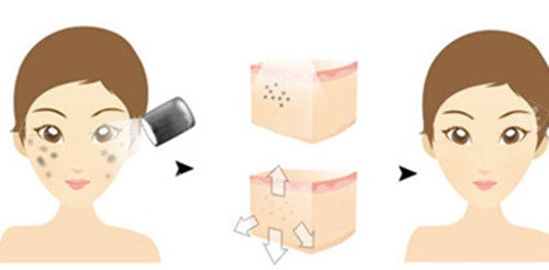 面部激光祛斑前后對(duì)比卡通示意圖