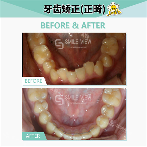 韓國(guó)smile view牙科牙齒矯正前后對(duì)比 韓國(guó)smile view牙科牙齒矯正前后對(duì)比